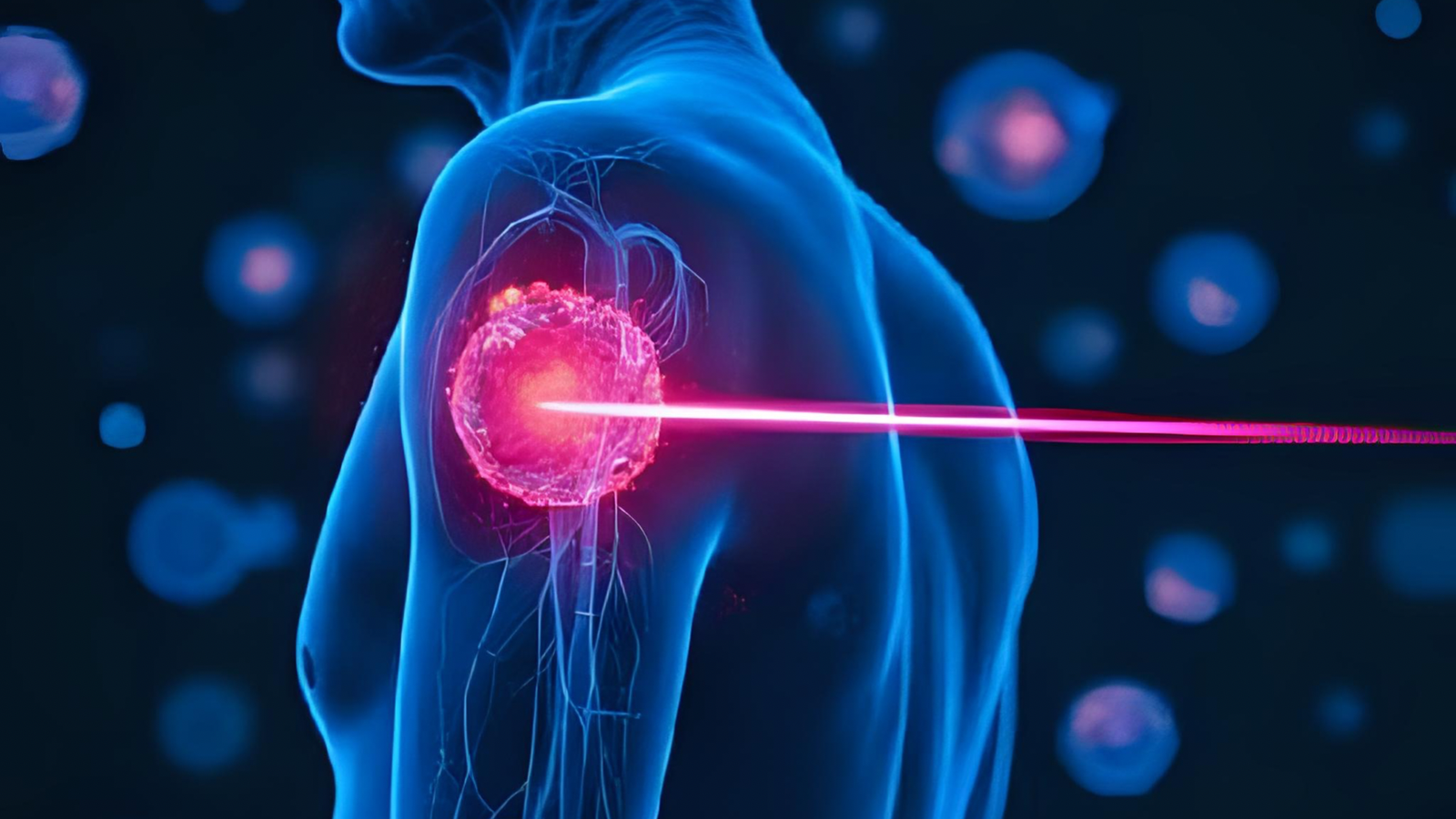 Cancer Treatment Breakthrough: Light-Based Therapy Destroys Cancer Cells with 99% Success Rate